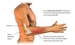 Infografía sobre el «Codo de Tenista»