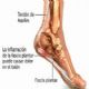 ¿Qué es la fascitis plantar? Consejos para prevenirla y tratarla