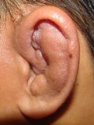 Lesiones en la oreja en los deportes de contacto