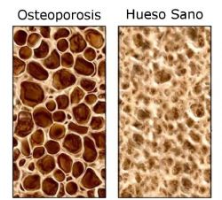 Osteoporosis, ¿qué es y cómo prevenirla?