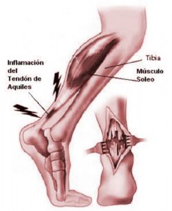 Tendinitis en el tendón de Aquiles