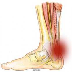 Lesiones habituales en el pie y sus síntomas más característicos