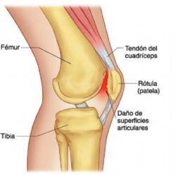 Lesiones del Corredor: Síndrome Femoro-Patelar (SFP)
