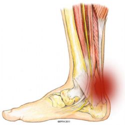 Aprende a identificar la bursitis