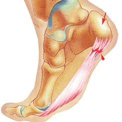 Fascitis plantar: Una patología típica en los corredores