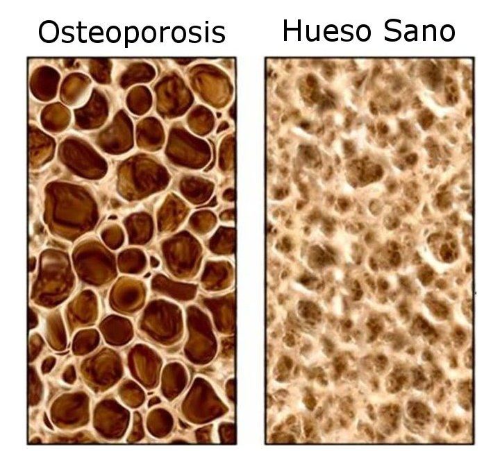 Osteoporosis, ¿qué es y cómo prevenirla?