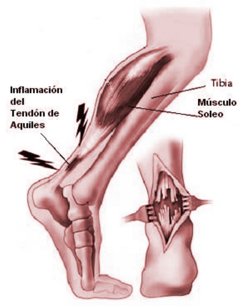 Tendinitis en el tendón de Aquiles